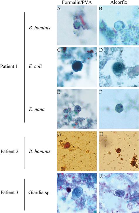 Clinical and analytical evaluation of a single vial stool collection ...